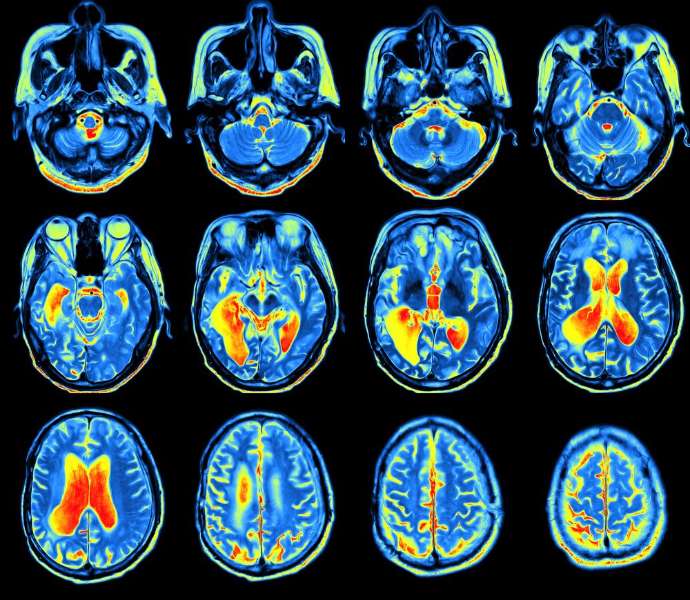 pet-scan-distinguishes-juvenile-hd-from-parkinson-s-in-case-study