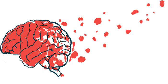 brain blood vessels | Huntington's Disease News | illustration of brain