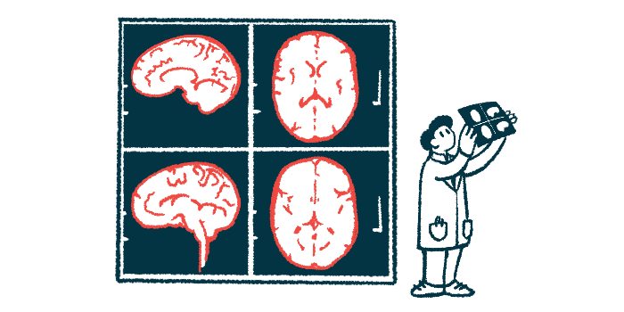 A clinician holds up an imaging scan alongside four giant images of the human brain shown on a wall.